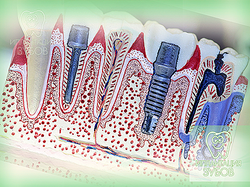 Beültetésre foggyökér - implantáció pin (implantáló) a foggyökér-