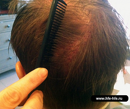 Implantarea părului