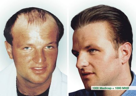 Імплантація волосся biofibre - оптимальне ліки від облисіння
