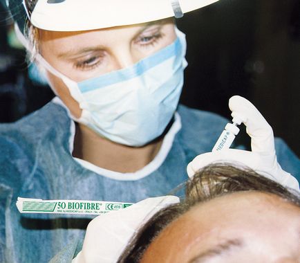 Імплантація волосся biofibre - оптимальне ліки від облисіння