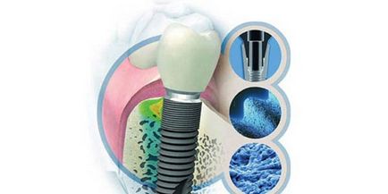 Імпланти astra tech - новаторські технології та якість - стоматологія на Таганці