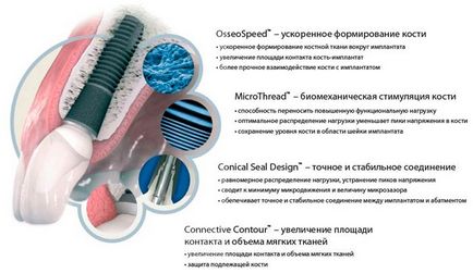 Implanturi astra tech - tehnologii inovatoare și calitate - stomatologie pe Taganka