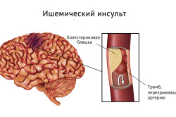 Simptome și consecințe ale accidentului vascular cerebral ischemic