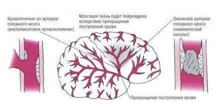 Ішемічний інсульт симптоми, причини хвороби і прогноз