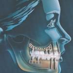 Corectarea unei ocluzii incorecte cu armăturile dentare