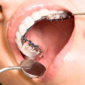 Korrekciója malocclusion A fogászati fogszabályozó (segítség) Korrekciója malocclusion A fogászati nadrágtartó