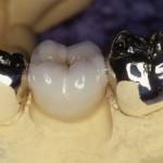 Corectarea unei ocluzii incorecte cu armăturile dentare