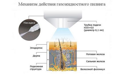 Cum funcționează peelingul lichid al capului de gaz și ce rezultate?