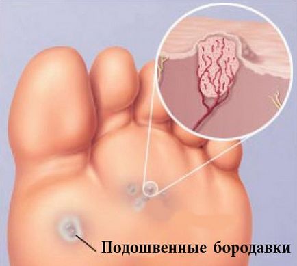 Як лікувати бородавки на стопі і на ногах