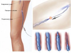 Як лікувати варикоз - сучасні методи