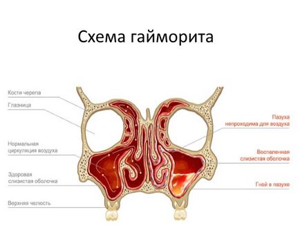 Як правильно застосовувати НІМУЛІД для дітей