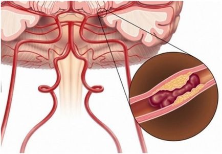 Cum de a recunoaște simptomele unui accident vascular cerebral și a unui accident vascular cerebral mic