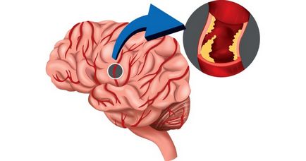 Cum de a recunoaște simptomele unui accident vascular cerebral și a unui accident vascular cerebral mic