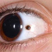 Úgy néz ki, mint egy melanoma arcán fotó - 22 db (melanoma arcán fotó) Mi melanoma képen arc - 22 db
