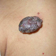 Cum arata melanomul pe fata fotografiei - 22 buc