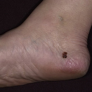 Úgy néz ki, mint egy melanoma arcán fotó - 22 db (néz) Mi melanoma képen arc - 22 db