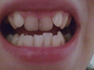 Cum să aliniați dinții fără brațe - moduri, eficiență