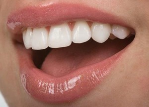 Як вирівняти зуби без брекетів - способи, ефективність