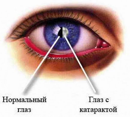 Semne de cataractă, simptome, tratament