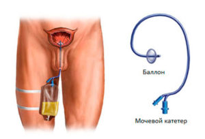 Cateter cu adenom de prostată - eficacitatea și cât de mult