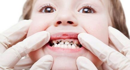 Komorowski - fogak kitörése, hasmenés során fogzás gyermekeknél, ezüst fogak, az első tünetek