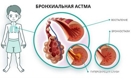 Компрес від кашлю дитині призначення і особливості застосування