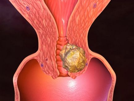 Кондиломи в уретрі у чоловіків і жінок