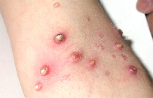 Moluște contagioasă - cauze, simptome și remedii populare pentru tratamentul molluscum contagiosum