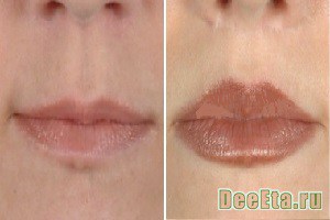 Lip corectarea