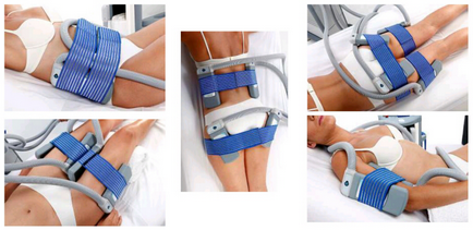 Cryolipolysis este un remediu inovatoare pentru celulele grase