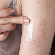 Tratamentul eczemelor la domiciliu