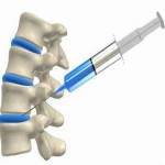 Tratamentul osteocondrozei la domiciliu