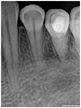 Tratamentul cariei complicate - clinica dentară dental-sv