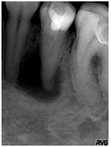 Лікування ускладненого карієсу - стоматологічна клініка дентал-св