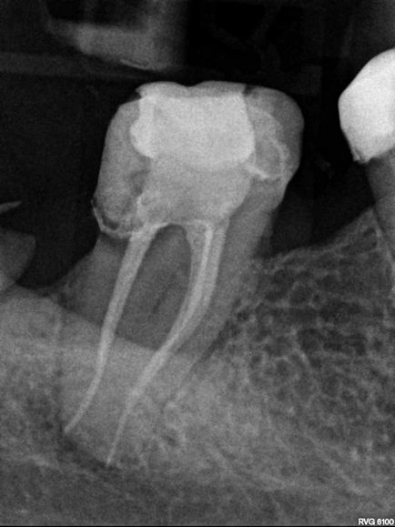 Tratamentul cariei complicate - clinica dentară dental-sv