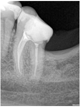 Лікування ускладненого карієсу - стоматологічна клініка дентал-св