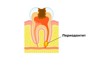 Лікування періодонтиту в стоматології зубки, комплексні етапи лікування періодонтиту у дітей в Самарі