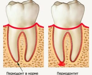 Tratamentul parodontitei în stomatologia dinților, stadiile complexe de tratament al parodontitei la copiii din Samara