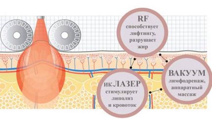 Ліфтинг радіочастотний відгуки, що це таке