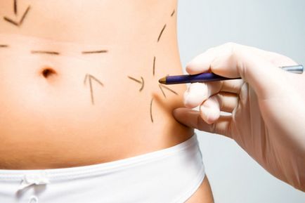 Liposucție cu ultrasunete tehnici invazive și neinvazive