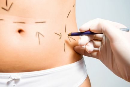 Ultrahangos zsírelszívás invazív és nem-invazív technikával (non-invazív) Ultrahangos zsírelszívás invazív és nem-invazív technikák