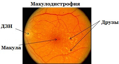 Degenerarea maculară a ochiului