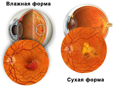 Degenerarea maculară a ochiului
