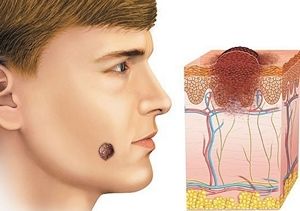 Melanomul pe față - de ce apar și cum să se ocupe de el