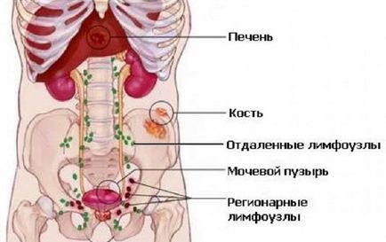 Метастази при раку простати основні види, причини, симптоми