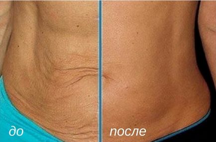 Mezoterapia abdomenului este rezultatul procedurii înainte și după, a medicamentelor utilizate pentru a înlătura grăsimea din abdomen