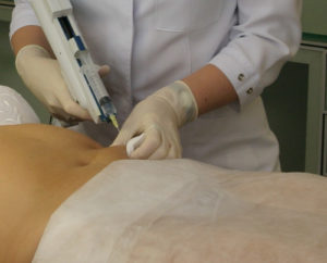 Mezoterapia abdomenului este rezultatul procedurii înainte și după, a medicamentelor utilizate pentru a înlătura grăsimea din abdomen