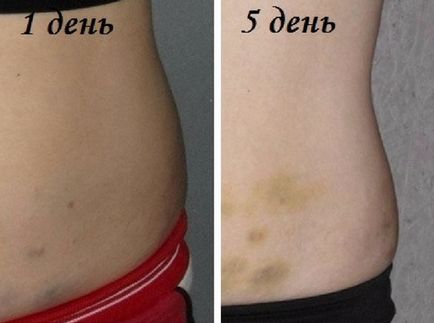 Mezoterapia abdomenului este rezultatul procedurii înainte și după, a medicamentelor utilizate pentru a înlătura grăsimea din abdomen