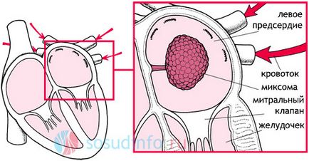 Heart malformație atrială, ventricul - cauze, tratament, simptome