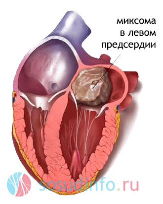 Heart malformație atrială, ventricul - cauze, tratament, simptome